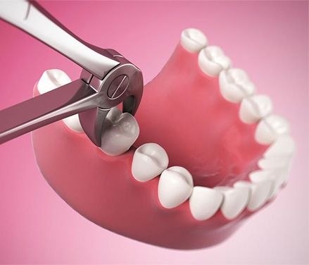 Tooth, Gum & Wisdom Extraction